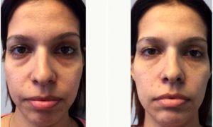 30 Year Old Woman Treated With Voluma With Dr Ava Shamban, MD, Santa Monica Dermatologic Surgeon