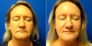 46 Year Old Woman Treated With Radiesse By Doctor Jack G. Bertolino, MD, Buffalo Physician Loading