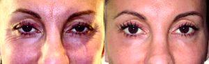 49 Year Old Woman Treated With Botox With Dr James R. Gordon, MD, FACS, FAAO, New York Oculoplastic Surgeon