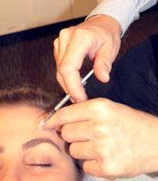 Botox Forehead Crease