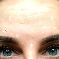 Botox Forehead Injections