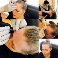 Botox Forehead Results