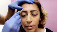 Botox Onabotulinumtoxina Injection