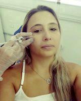 Botox Sites Injection Face