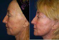 Doctor Ran Y. Rubinstein, MD, Manhattan Facial Plastic Surgeon - Sculptra Liquid Lift
