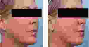 Doctor Victor Chung, MD, San Diego Facial Plastic Surgeon - 47 Year Old Woman Treated With Juvederm