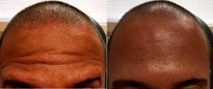 Dr Michael T. Somenek, MD, Washington DC Facial Plastic Surgeon - 35 Year Old Man Treated With Dysport To The Forehead