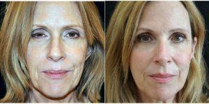 Dr Mitchell Schwartz, MD, South Burlington Dermatologic Surgeon - 57 Year Old Woman Treated With Sculptra