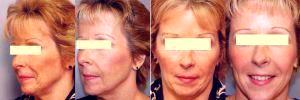 Dr. Joel B. Singer, MD, New York Plastic Surgeon - Sculptra Treatments