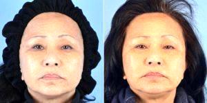 Dr. Landon Pryor, MD, FACS, Rockford Plastic Surgeon - 65 Year Old Woman Treated With ArteFill