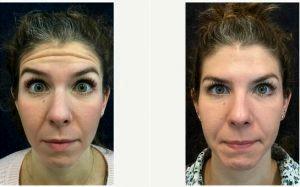 Dr. Larry Lickstein, MD, Fairfax Plastic Surgeon - 30 Year Old Woman Treated With Dysport