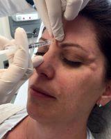 Get Rid Of Forehead Frown Lines