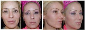 Sculptra By Dr. Brooke R. Seckel, MD, FACS, Boston Plastic Surgeon