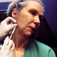 What Is Onabotulinumtoxina Injection