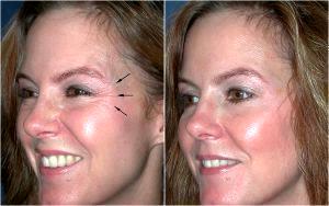 Сrow's Feet Wrinkles By The Eyes, Exacerbated With Squinting And Smiling By Plastic Surgeon Dr. David Mabrie With Botox Or Dysport