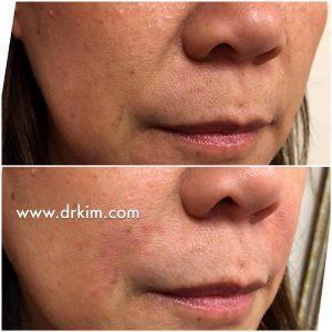 1 Syringe Of Juvederm In Nasolabial Folds By Dr.Kim,San Francisco