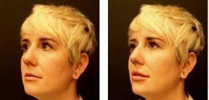 1 Syringe Of Juvederm Ultra Plus XC In The Upper And Lower Lips By Dr. Remus Repta, MD, Phoenix & Scottsdale Cosmetic Plas