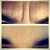 12% Of Total Botox Cosmetic Procedures Are Performed On Males