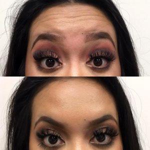 15 Units Of Xeomin By Lisa Azevedo RN At Laser Clinique In San Diego, California