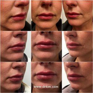 2 Syringes Of Juvederm Volbella By Dr. Kim,San Francisco