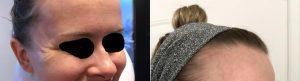 32 Year Old Woman Treated With Botox By Doctor Shamim Shakibai, MD, Los Angeles Physician