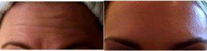 33 Year Old Woman Treated With Botox With Doctor Supriya Tomar, MD, West Palm Beach Dermatologic Surgeon