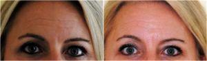 40 Unit Of Botox, Glabella, Forehead And Crows Feet By Dr. Avron Lipschitz, MD, Palm Beach Gardens, FL Plastic Surgeon