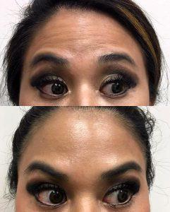 A Little Xeomin By Dr. P. Alexander Ataii, M.D., Dermatologist In San Diego, California