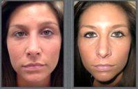 A Minimally Invasive Answer To Fixing Wrinkles