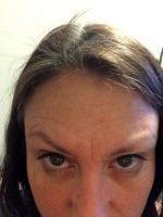 Administer Botox To The Specified Facial Area