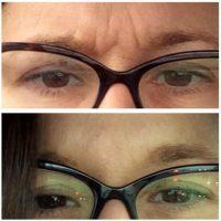 Affordable Botox For Frown Lines In San Diego