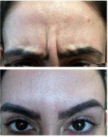 Amazing Purified Proteins Work By Relaxing The Muscles