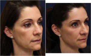 Artefill By Dr. Andre Berger, MD, Beverly Hills CA Physician