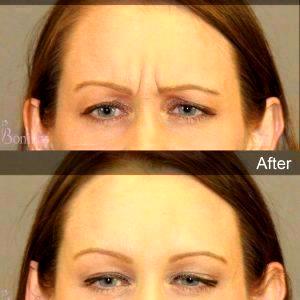 BOTOX Cosmetic Treatment
