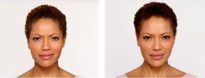 Before And After Botox In UT