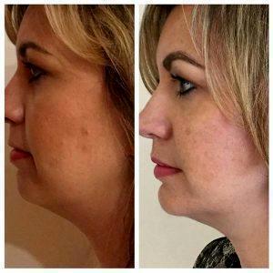 Before And After Kybella Jaw Sculpting By Los Angeles Cosmetic Surgeon Dr. Alexander Rivkin