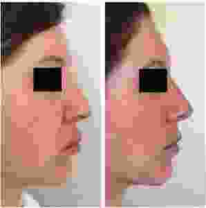 Before And After Non Surgical Nose Job Using Voluma By Los Angeles Cosmetic Surgeon Dr. Robert Cohen