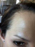 Best Botox West Palm Beach