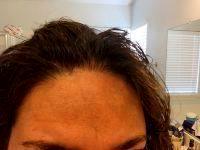 Best Los Angeles Botox