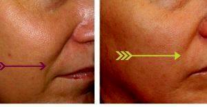 Botox And Fillers By Dr. Jepson,Salt Lake City