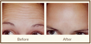 Botox At Avalon Laser, Skin Care Clinic In San Diego, California