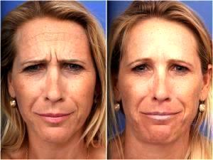 Botox At Lasky Aesthetics & Laser Cente, Medical Spa In Beverly Hills, California
