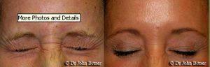 Botox At Layton Botox Cosmetic