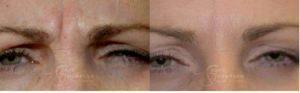 Botox Before And After Results By Dr. Scott K. Thompson,Salt Lake City