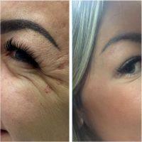 Botox Botulinum Toxin Type A By Dr. Garrett M. Crabtree, Louisville Plastic Surgeon