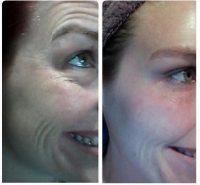 Botox Botulinum Toxin Type A Results With Dr. Miguel Delgado, San Francisco Plastic Surgeon