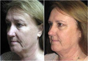 Botox By Dr. Daniel Barrett, Plastic Surgeon In Beverly Hills, California