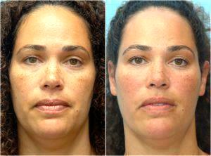 Botox By Dr. David Mabrie, San Francisco