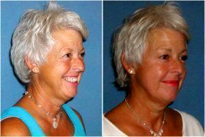 Botox By Dr. Emilio Justo,Arizona