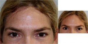 Botox By Dr. Mark R. Murphy, MD, Plastic Surgeon In Palm Beach Gardens, Florida